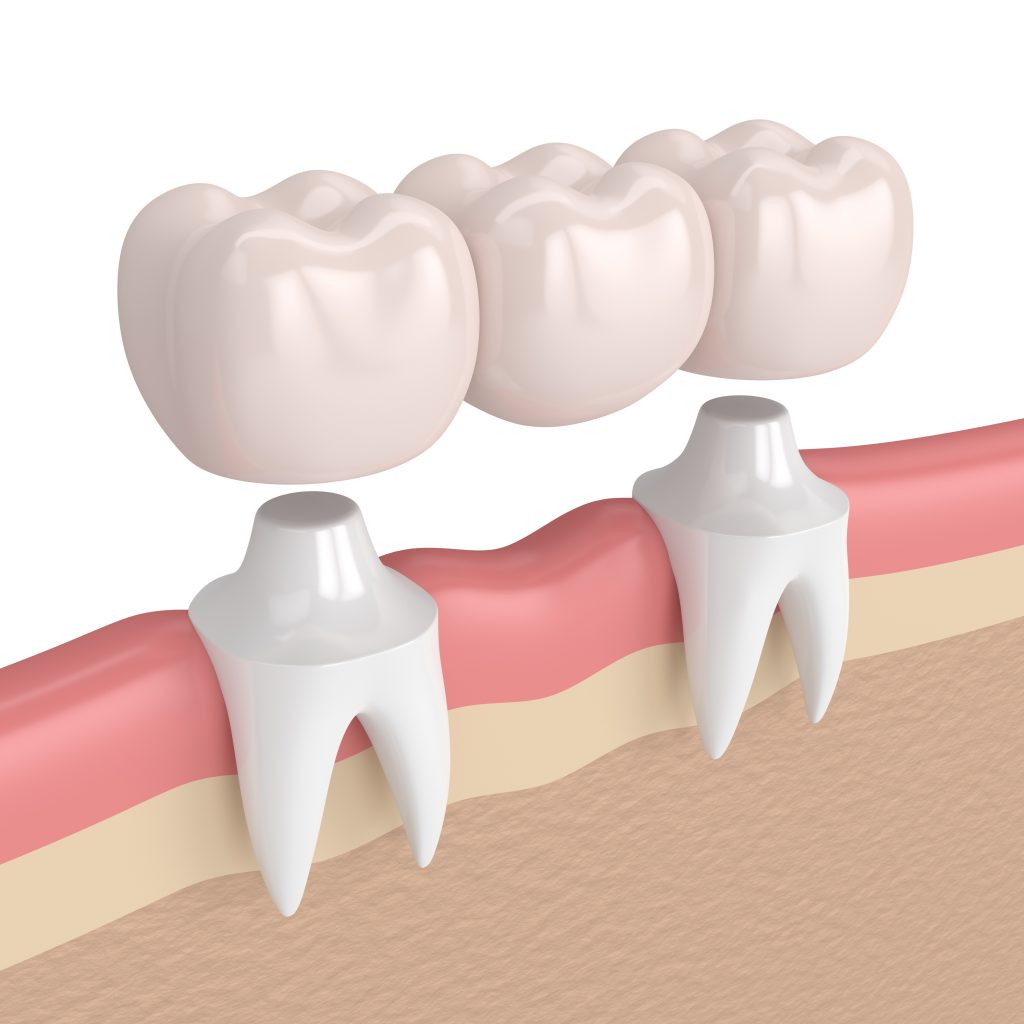graphical representation of a dental procedure