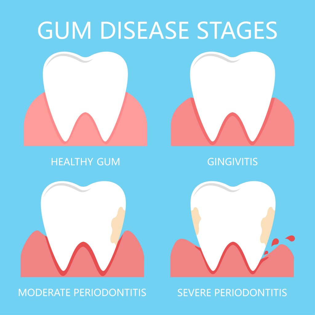 gum disease stages