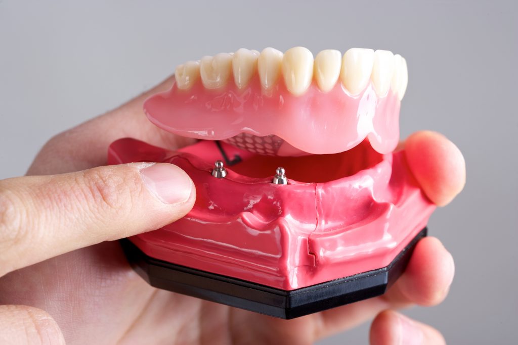 finger pointing at implants that server as mount points for dentures