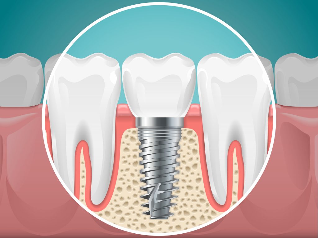 Graphical representation of a tooth with a dental implant